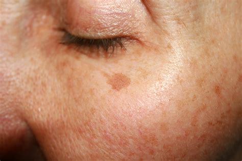 dark spots on skin and eyes